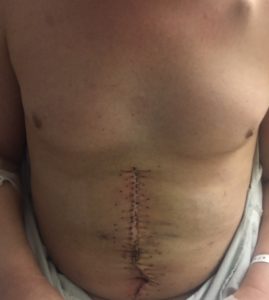 Howard's abdomen after surgery.